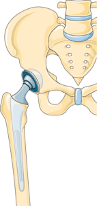 Terapia osteopatyczna w obrębie miednicy