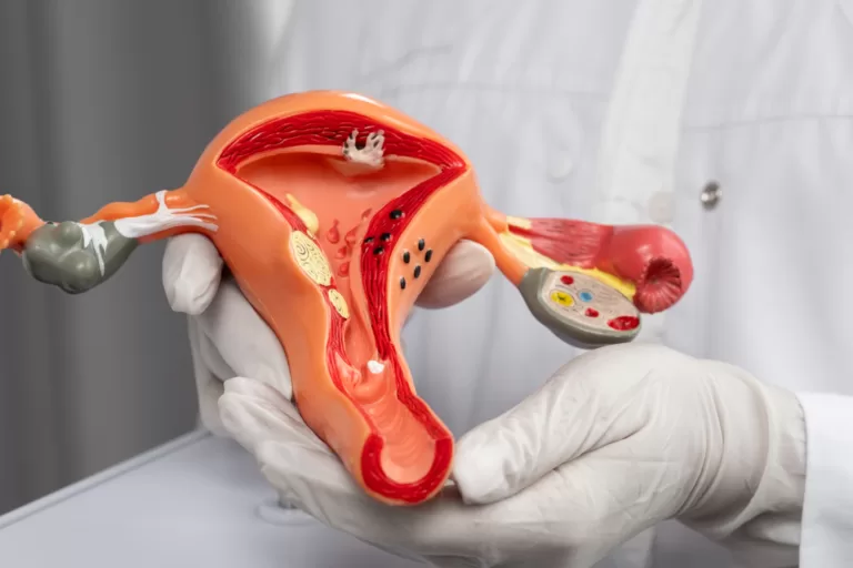 Endometrioza – objawy, przyczyny i skuteczne metody leczenia